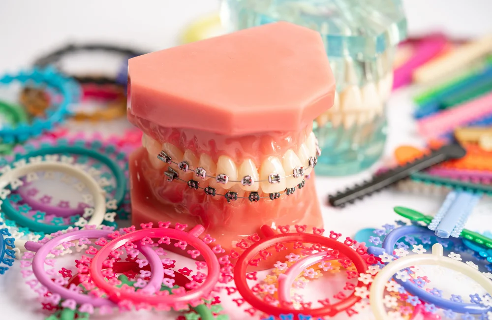 การใส่เชนจัดฟัน