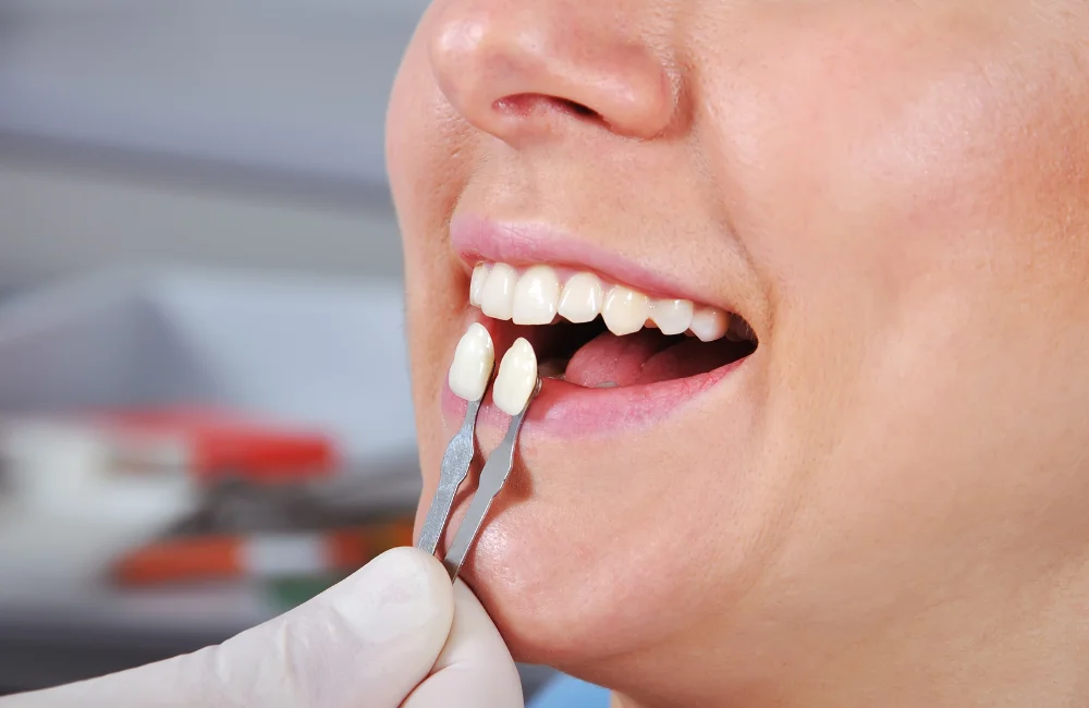 การแก้ฟันห่าง