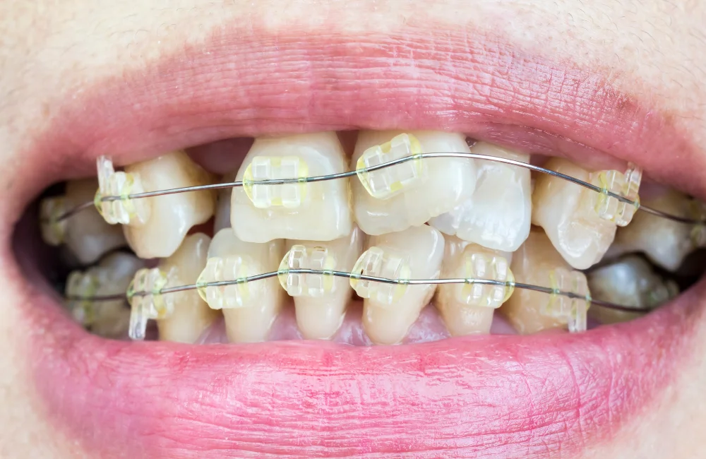 การจัดฟัน