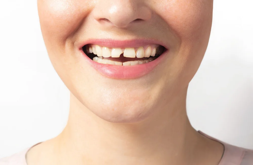 ฟันแตก ฟันหัก