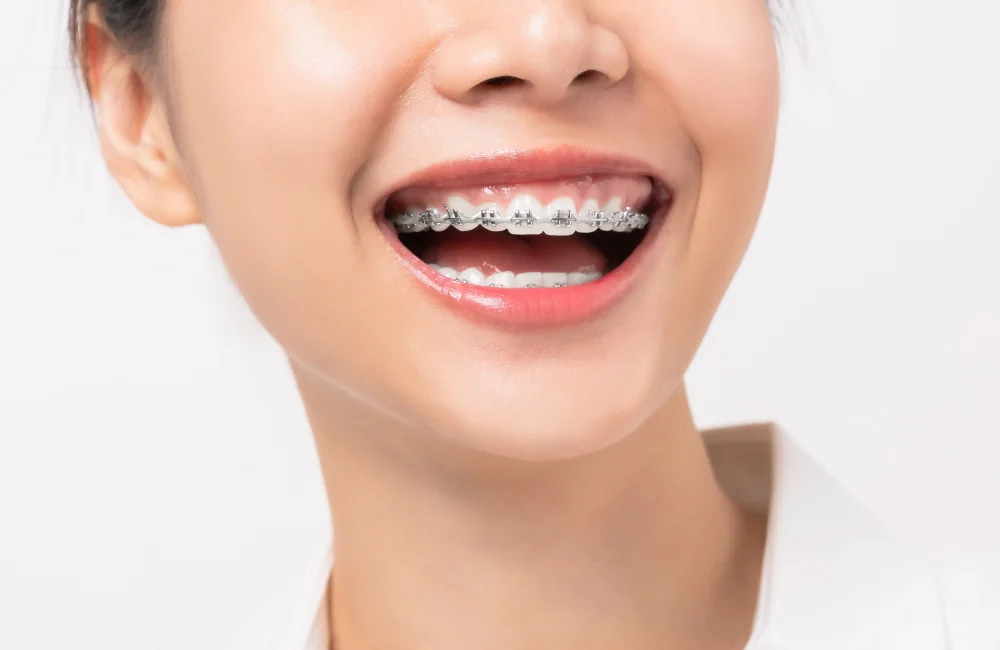 ข้อดีของการจัดฟันราคานักเรียน