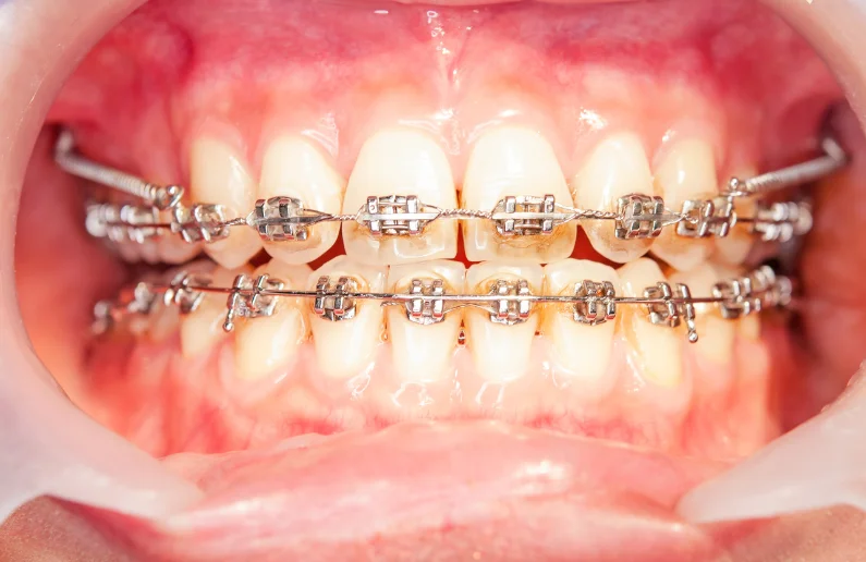 ปักหมุดฟัน