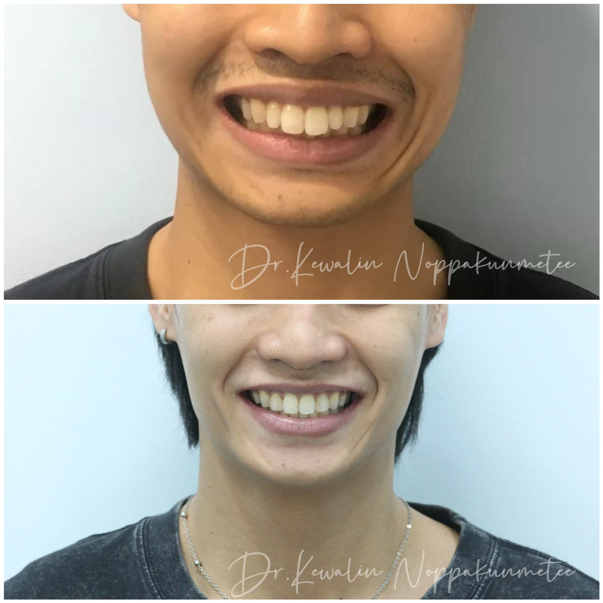 รีวิววีเนียร์