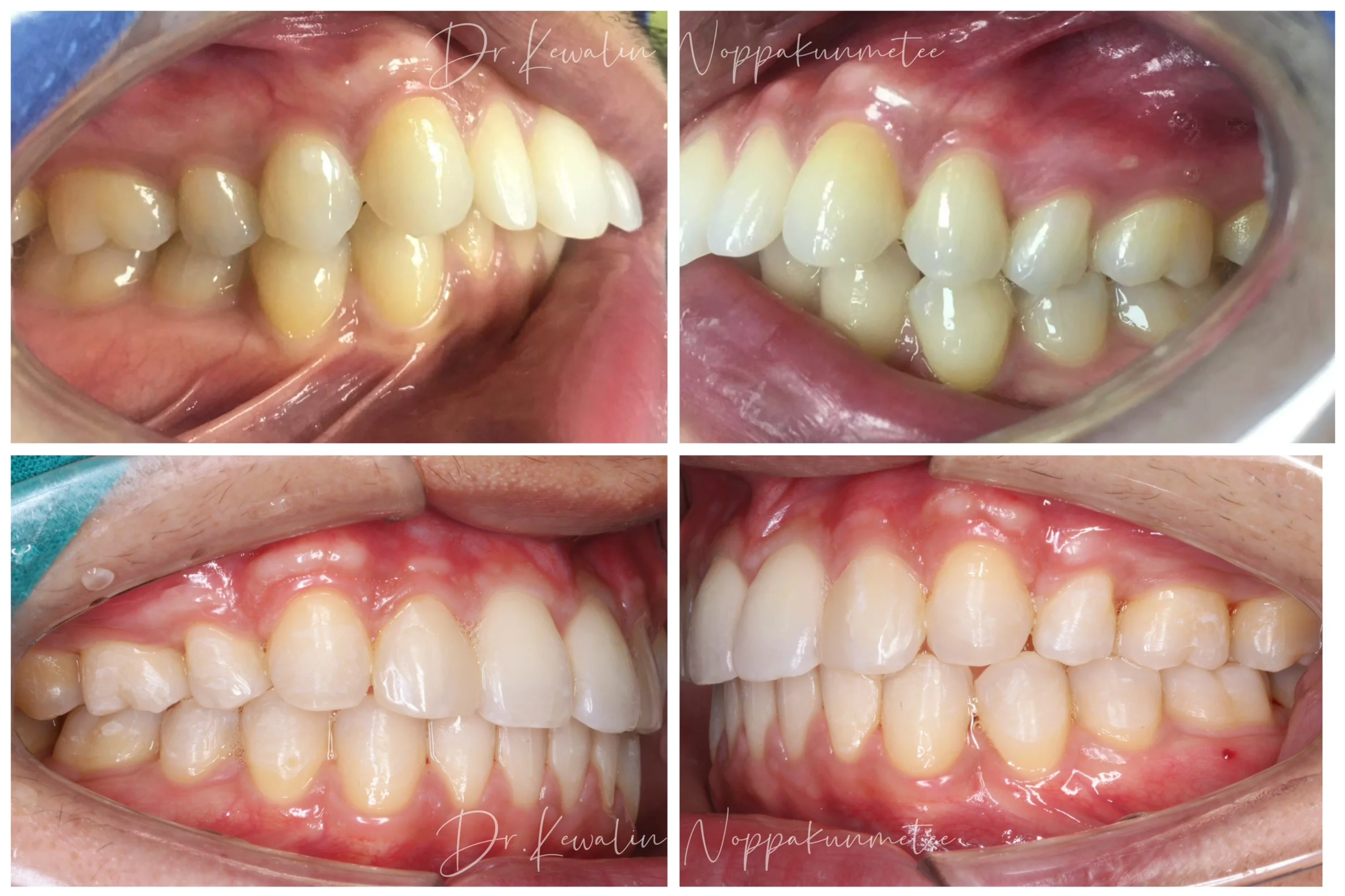 รีวิววีเนียร์