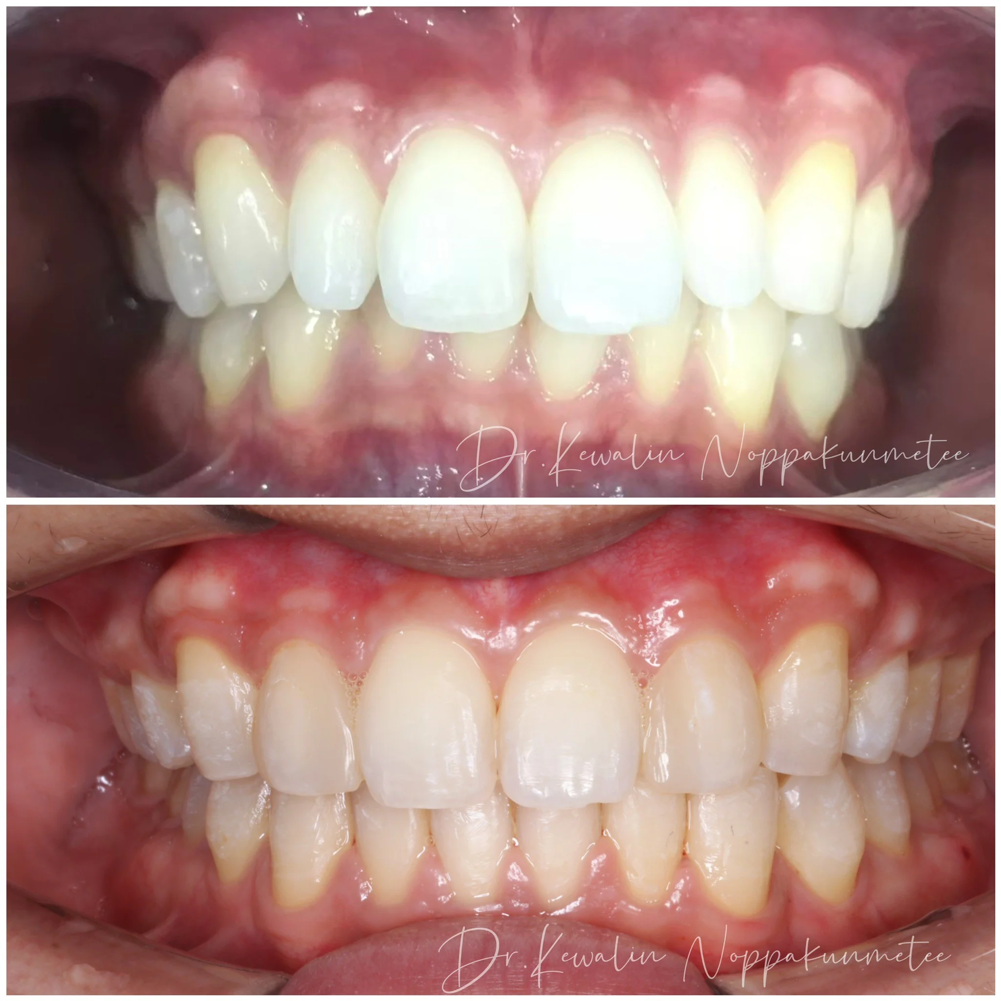 รีวิววีเนียร์