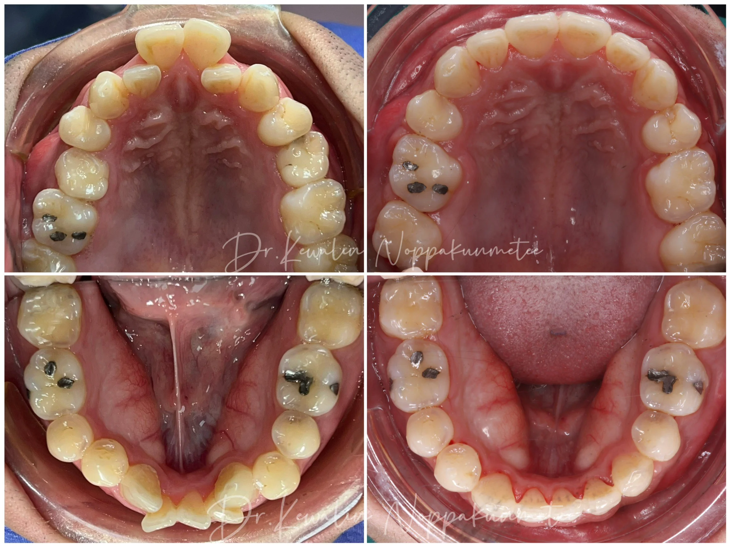รีวิววีเนียร์