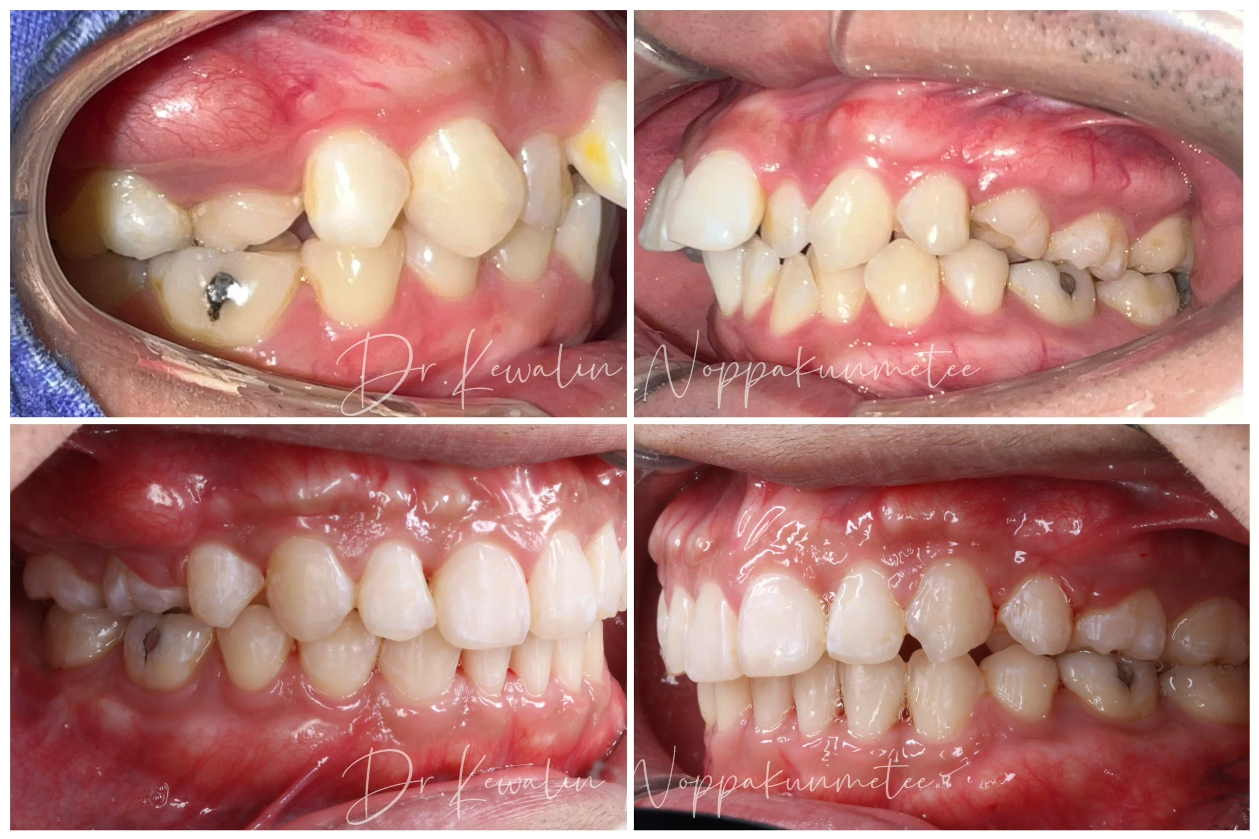 รีวิววีเนียร์