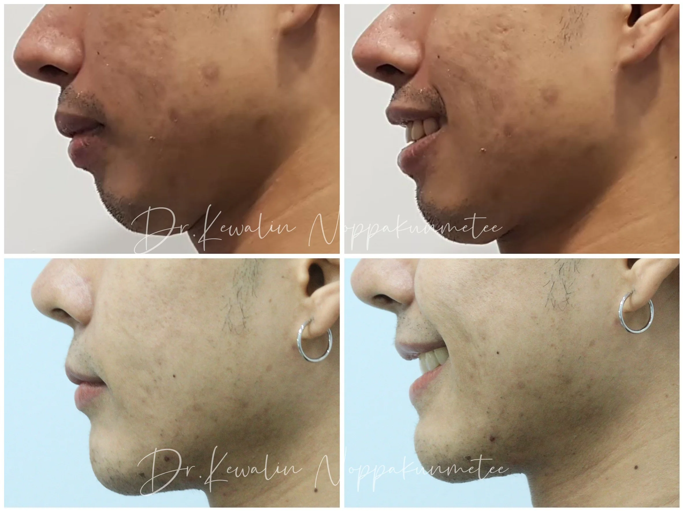 รีวิววีเนียร์