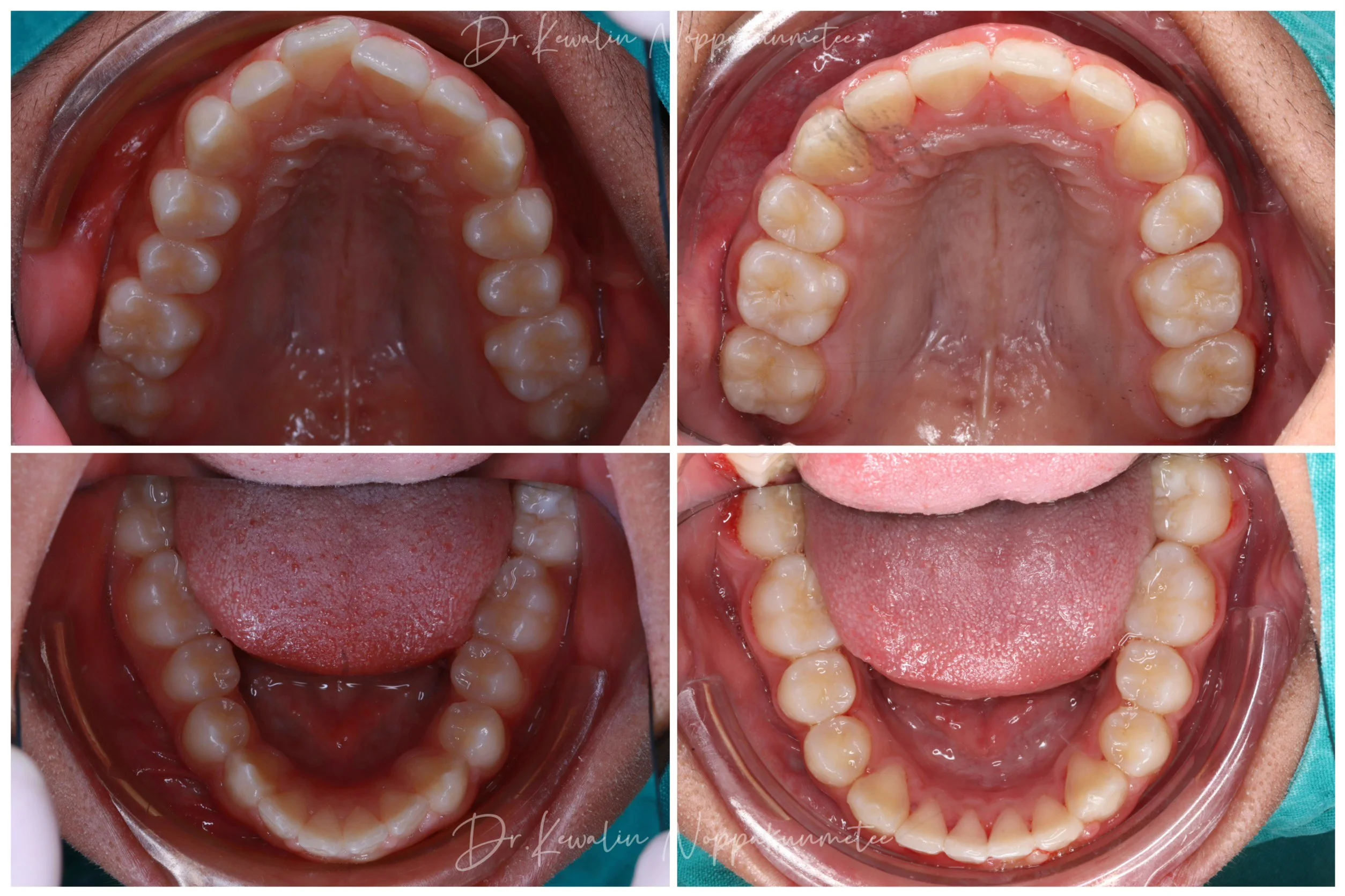 รีวิววีเนียร์