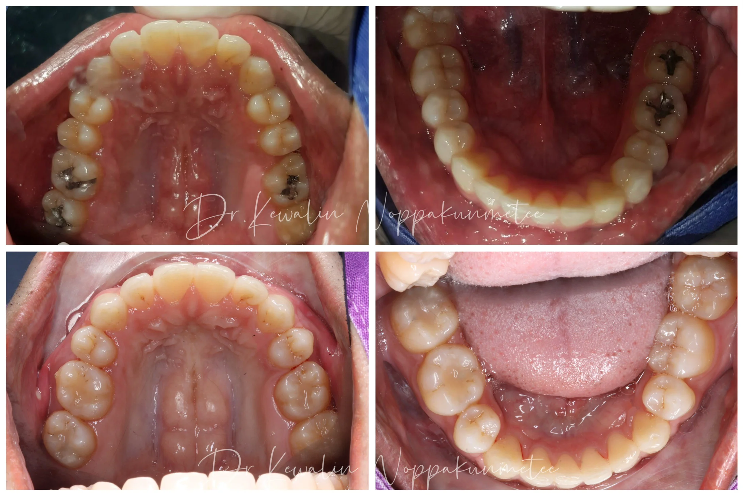 รีวิววีเนียร์