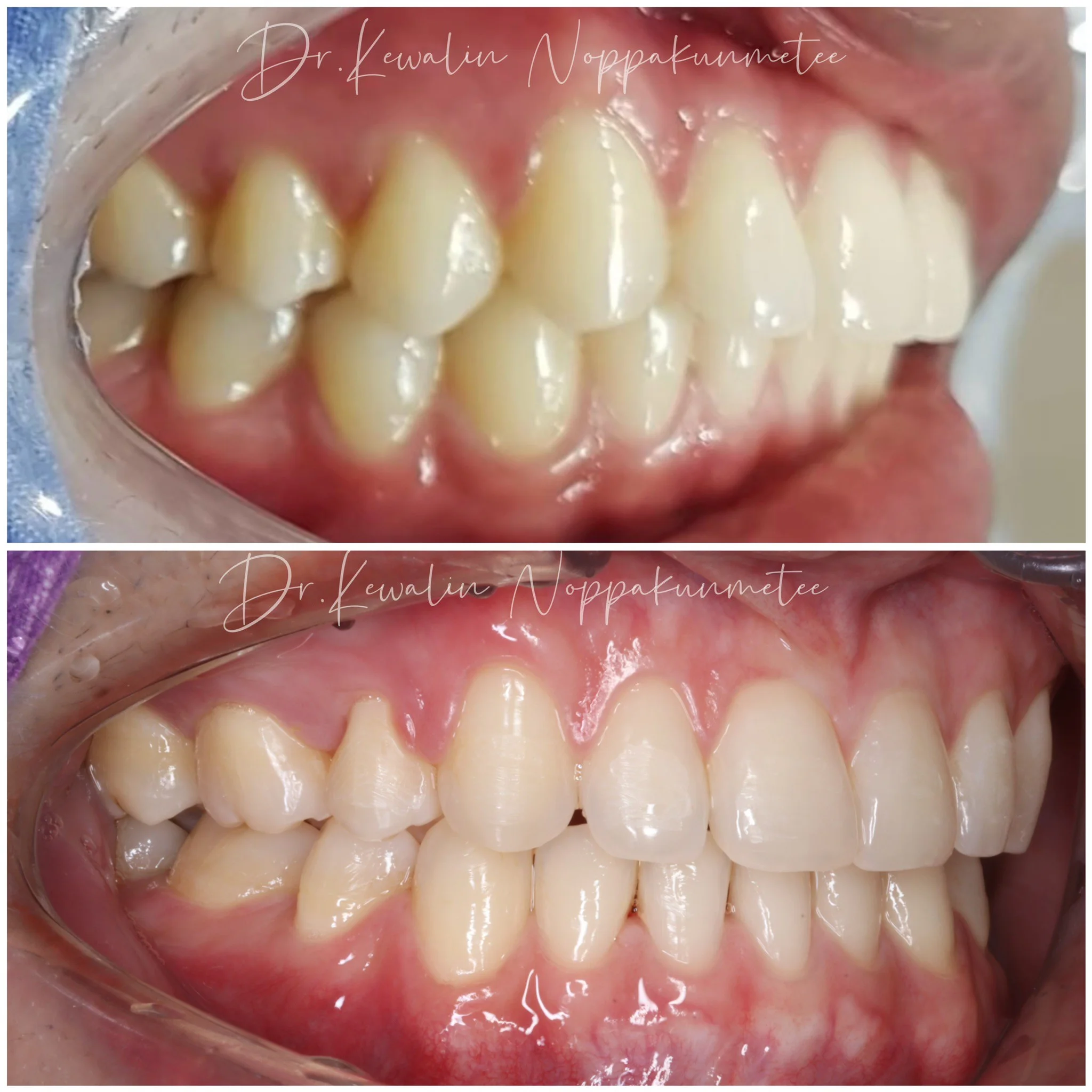 รีวิววีเนียร์