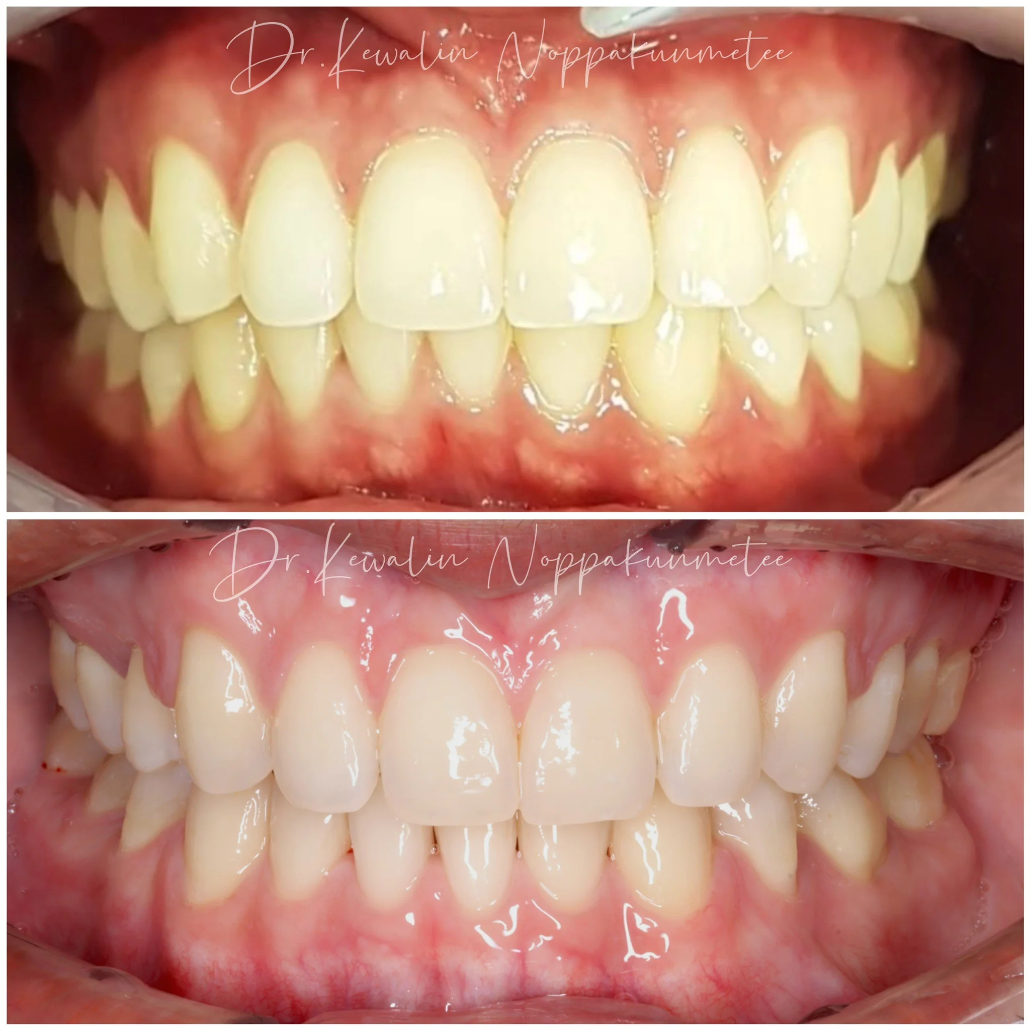 รีวิววีเนียร์