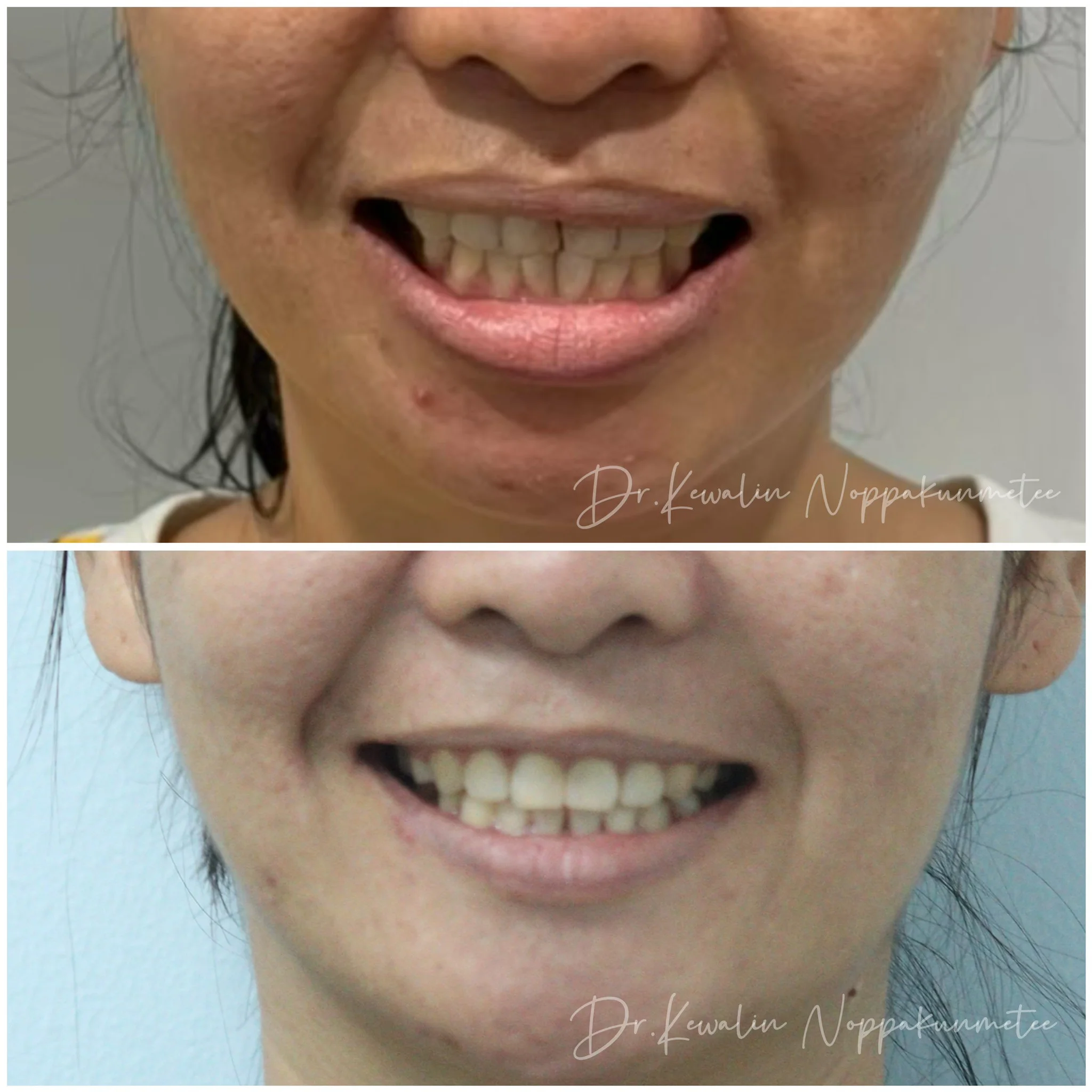 รีวิววีเนียร์