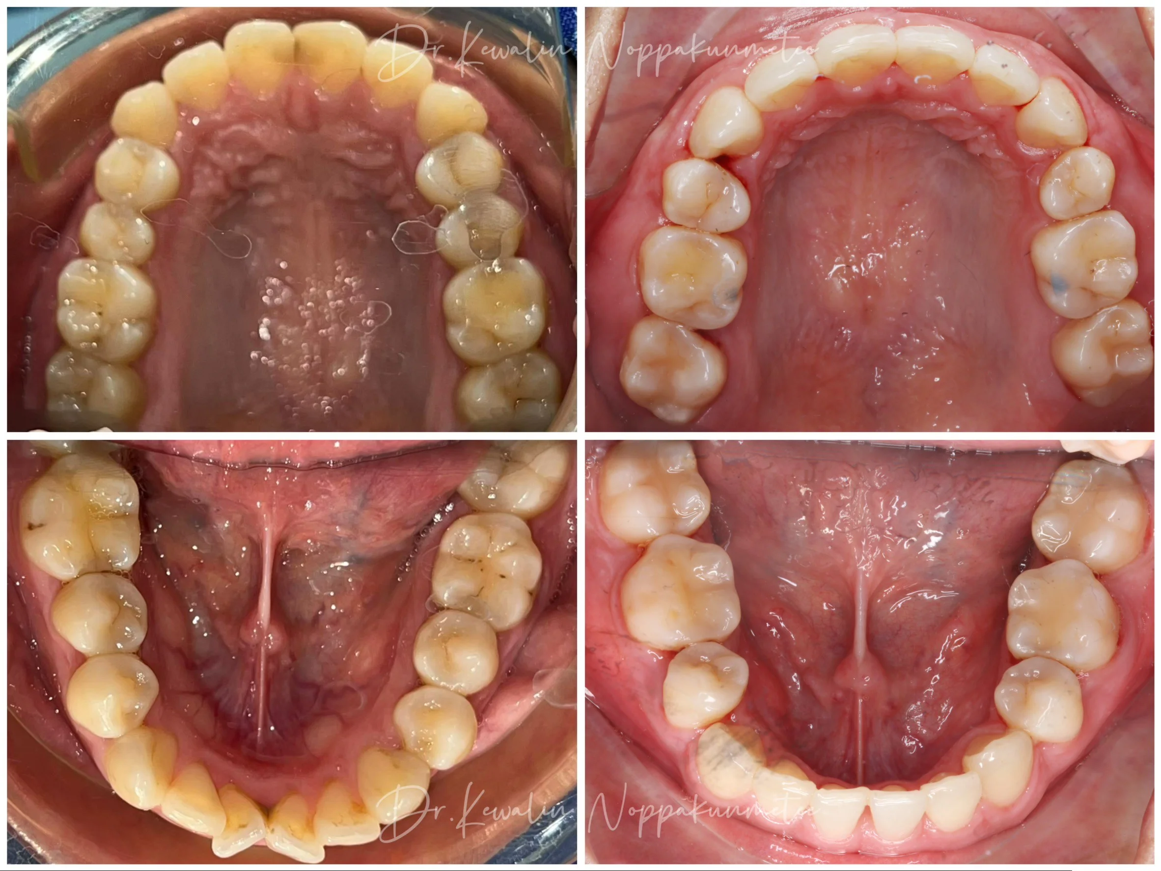 รีวิววีเนียร์