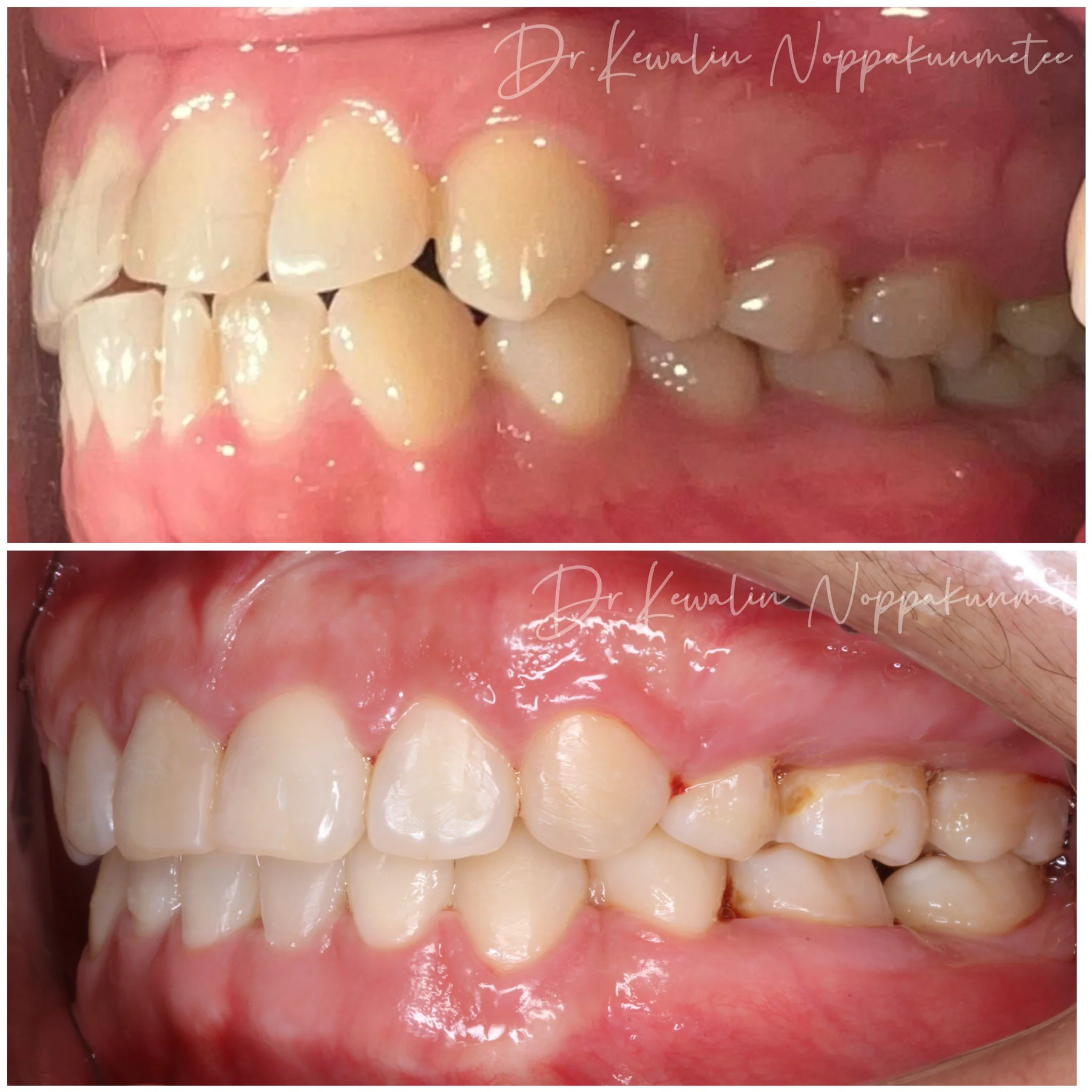 รีวิววีเนียร์