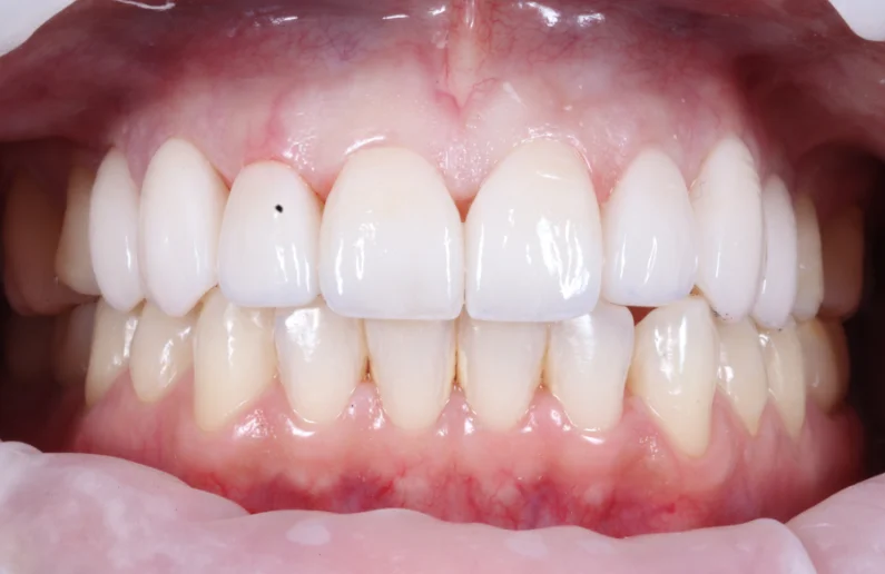 รีวิววีเนียร์