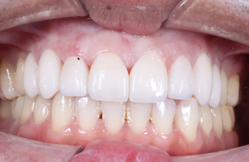 รีวิววีเนียร์