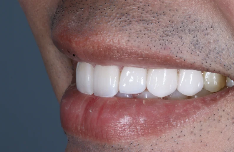 รีวิววีเนียร์